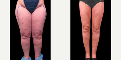 Woman treated with Lipedema Surgery - Woman treated with Lipedema Surgery
