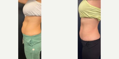 25-34 year old woman treated with Evolve, Semaglutide - Treated by Tracy Kwan, PA and by Alyssa G, laser tech