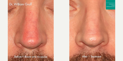 25-34 year old man treated with Vbeam - Vbeam and AcuPulse lasers to treat redness