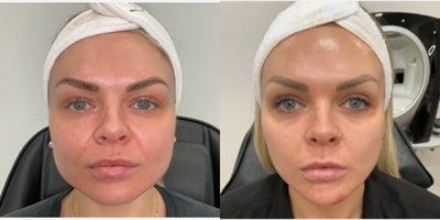 35-44 year old woman treated with AccuTite - This Calgary woman felt she had premature aging related to increased volume to her lower face. For some patients this happens with weight gain, others its just part of aging, for this patient it was genetics. AccuTite bridges the gap between face lifting and skin tightening. It is the only device that offers what was once only a surgical option, now an outpatient procedure. As the only AccuTite providers in Calgary, we recommend booking a consultation to know if this is the right option for you!