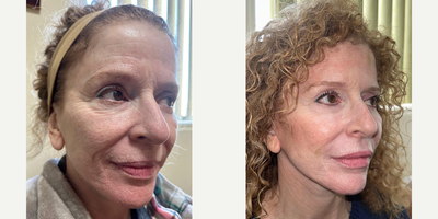 Woman treated with Nonsurgical Facelift, Nonsurgical Neck Lift - Non-surgical face & neck lift using laser & ultrasound.