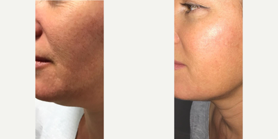 Woman treated with Smart Lipo, Laser Liposuction, Chin Liposuction, Liposculpture - Smartlipo removes fatty drops & tightens the skin.No scarring3-5 days of recoveryLocal anesthesia & light oral sedation