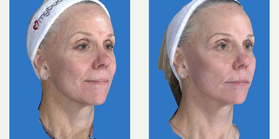 59 year old woman treated with Laser Resurfacing - 59 year old female who underwent a first facelift by another doctor at 50. She did not care to undergo another surgery but wanted to correct the wrinkles and sun spots of face. Smartskin CO2 laser was used on her face, neck and eyelids. She also had a little Dermal filler (Juvederm) in the lips, cheeks and nasolabial folds. This has produced a very natural rejuvenation without surgery.