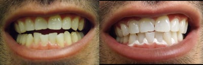 Young Male After ZOOM Teeth Whitening - 
	Here is a before and after pictures after a Zoom whitening session. The patient still has the Zoom whitening paste - but you can clearly see that the teeth is at least a couple of shades whiter.
