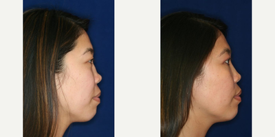 Permanent Non-surgical Rhinoplasty - Restoration to pre-injury appearance after accident leading to collapse of the bridge.