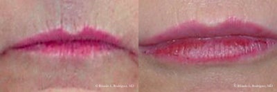Lip Augmentation - 	This patient had a desire for full lips. Enhanced this patient's upper and lower lips with fat injections, sometimes known as fat transfer to the lips. The fat was taken from the abdominal area, processed with a centrifuge, and then injected into the upper and lower lips. The procedure not only enhanced the size of the lips, but it also removed some of the fine wrinkles that the patient had around her lips.