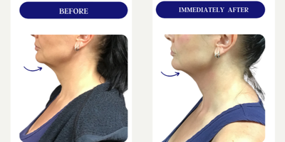 45-54 year old woman treated with Fractora RF, Forma, Facial, Skin Tightening, Skin Rejuvenation - FRACTORA FIRM-FORMAbipolar radiofrequency
