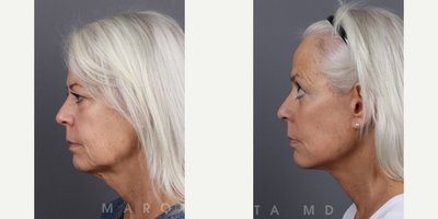 Woman treated with Deep Plane Facelift, Facelift, Neck Lift, Facial Fat Transfer, Eyelid Surgery - Facial RejuvenationOur patient achieved remarkable results with:Deep Plane Face & Neck LiftLower BlepharoplastyFat Transfer