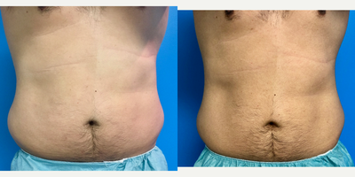 35-44 year old man treated with CoolSculpting - CoolSculpting of flanks