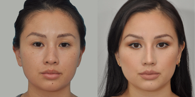25-34 year old woman treated with Asian Rhinoplasty - I strengthened her nasal tip using extended tissue from inside the nose to increase projection while simultaneously making her nose less upturned. This makes the tip stronger and narrower and prevents widening upon smiling. No direct nostril narrowing was needed. An added benefit of strengthening the internal structures of the nose (as opposed to simply laying materials on top of the existing nose) is that the nose can be made almost perfectly straight. The bridge was built up using tissues from behind the ear- notice her right ear appears completely normal. When the nose needs reshaping rather than increased bulk, no rib is needed. This is a 3.5 hr operation with a 7 day recovery. No bones were broken. I call this an Organic Rhinoplasty because no synthetic materials are used.