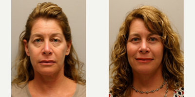 Woman treated with Cheek Augmentation - Woman treated with Cheek Augmentation through facial fat transfer from abdomen. She also had Deep Plane Facelift,Chin Liposuction,Upper and Lower Eyelid Blepharoplasty, andTemple Brow Lift.Patient already tried Botox and fillers in the past but it did not fully treat her concerns.