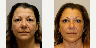 Woman treated with Cheek Augmentation - Woman treated with Cheek Augmentation through facial fat transfer as well as Upper and Lower Blepharoplasty. Patient was concerned with her tired-looking eyes and felt that her eyes looked heavy.