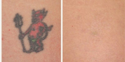 Tattoo Removal by Dr. Groff - Tattoo Removal by Dr. Groff