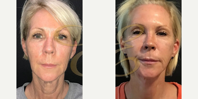 Woman treated with Mini Facelift - Woman treated with Mini Facelift
