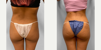 25-34 year old woman treated with Butt Lift, Liposuction, Tummy Tuck - This woman in her late twenties wished to improve the appearance of her abdomen after three children and met with Dr. Tucker to see her options for body contouring. She chose to have a tummy tuck with liposuction of the hips and flanks along with BBL fat injections to the buttocks. She looks great and is featured before and three months after surgery.