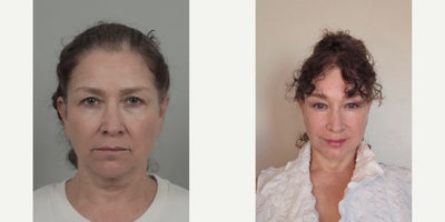 55-64 year old woman treated with AccuLift, Facelift, Lip Fillers, SMAS Facelift - .