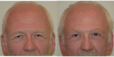 70 year old male treated with Direct Brow Lift and Upper Eyelid Blepharoplasty - This pleasant 70 year-old male presented with a chief complaint of visual field loss and an aged appearance of his upper and lower eyelids.  He is extraordinarily active for his age, regularly participating in mountaineering, and kayaking along with other outdoor activities.  This gentleman's ability to see well is critical.  On physical examination he has significant brow ptosis (drooping) as well as dermatochalasis (excessive eyelid skin).  I do not believe that an upper eyelid blepharoplasty alone would have achieved the functional improvement necessary to correct his visual field loss sufficiently and therefore a brow lift in addition to an upper eyelid blepharoplasty was performed to correct his condition approriately as well as satisfy his aesthetic expectations.