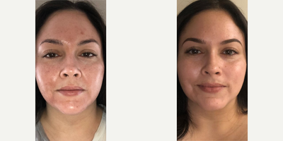 Woman treated with VI Peel - Woman treated with VI Peel