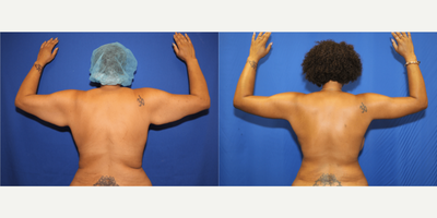 35-44 year old woman treated with Back Lift - This patient in her mid-40s was unhappy with her back rolls after losing 200 pounds. She desired a flat back. The doctor was able to remove excess skin and fat of her back by performing an upper body lift (also known as a torsoplasty).