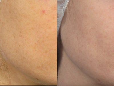 Photodynamic therapy - PDT - 	Before and after 2 photodynamic therapy sessions with Levulan for sundamage and brown spot treatment.