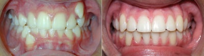 Teen Orthodontic Treatment (case #1BG) - 
	Treatment began with the use of dentofacial orthopedics, followed by conventional braces. No permanent teeth were removed.
