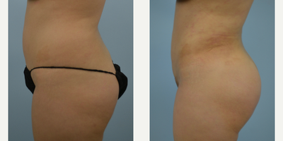25-34 year old woman treated with Brazilian Butt Lift - Liposuction with Fat Transfer to the Buttocks