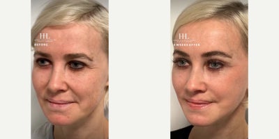 Woman treated with Lip Lift - Woman treated with endoscopic Brow Lift, Eyelid Surgery through upper blepharoplasty, Deep Plane Facelift, Neck Lift, and a subnasal Lip Lift. Patient is shown before and 4 weeks post-op.