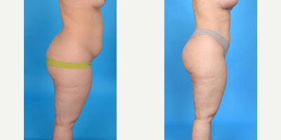 35-44 year old woman treated with Breast Fat Transfer - Breast Fat Transfer: 600cc/breast. Liposuction from abdomen, flanks: Lipo 360