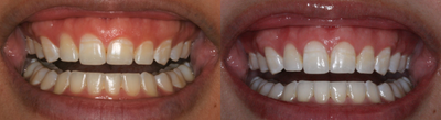 25-34 year old woman treated with Gum Lift - Patient came to office with a gummy smile that she's had all her life and had a learned lip position so that when she smiles, it wouldn't show all of her gums. The doctor states that patient has a lot of enamel still underneath gums and corrected smile so that the gum line would be more symmetrical.