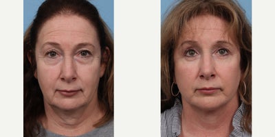 55-64 year old woman treated with Facelift, Eyelid Surgery - 3 months post op