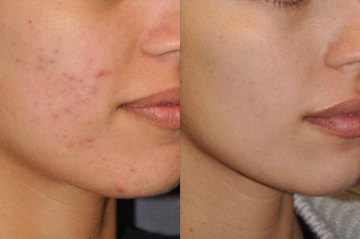 Woman treated with Microdermabrasion - Woman treated with Microdermabrasion for a deep pore cleanse & exfoliation of the skin