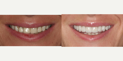 18-24 year old woman treated with Six Month Smiles - She came into to see Dr Michaelson for a thorough dental examination after not having her teeth checked for years. Dr Michaelson put a treatment plan together into phases in order to get Allison back to optimal dental health. This plan would include a series of cleanings and restorative treatment like root canals, and removing all the old bonding and porcelain work that was either broken or had decay. Dr Michaelson then placed a combination of 10 esthetic porcelain crowns and veneers on her upper teeth.&nbsp;