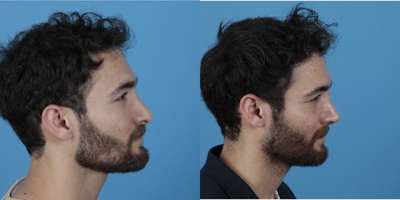 25-34 year old man treated with Revision Rhinoplasty - 20 days after revision Rhinoplasty what a great change he get