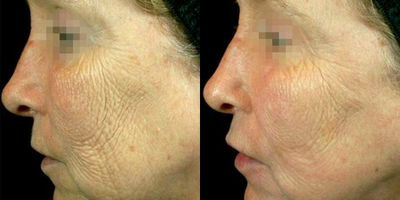 Woman treated with Pearl Laser - Pearl Laser