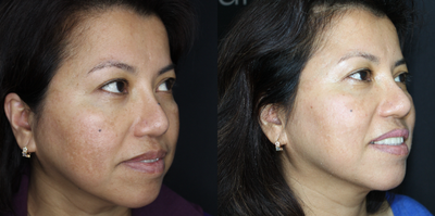 55-64 year old woman treated with Obagi Nu-Derm - Three months of Obagi Nu-Derm and routine Hydrafacials with TriHex Booster