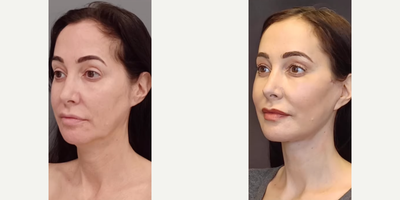 Woman treated with Brow Lift - Woman treated with Deep Plane Facelift, Lateral Brow Lift, and Facial Fat Transfer, shown 1 month post op.