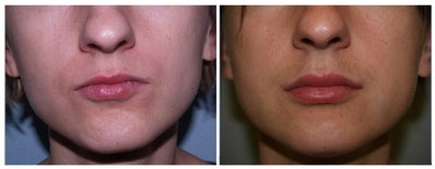 Silikon 1000 - 
	This patient was interested in achieving fuller lips. She underwent permanent lip augmentation with use of Silikon 1000 injections.
