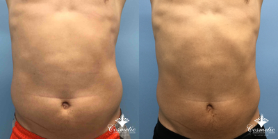 Man treated with Emtone - Man treated with Emtone to abdoment. Patient underwent4 treatments of Emsculpt and Vanquish.