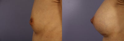 Inverted Nipple Repair - Patient with left inverted nipple, desired larger breasts and repair of inverted nipple and breast augmentation.