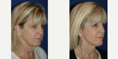 55-64 year old woman treated with Facelift - Lateral SMASectomy facelift with platysmaplasty neck lift.