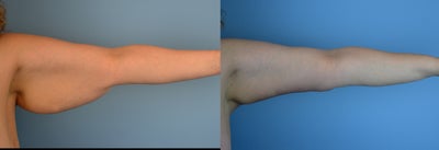35-44 year old woman treated with Arm Lift - Brachioplasty performed on 41 year old female.