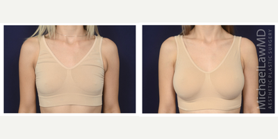 25-34 year old woman treated with Mentor Breast Implants - Breast augmentation. Follow-up photo taken 3 months after the procedure.