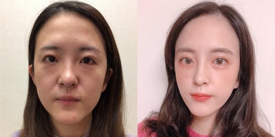 25-34 year old woman treated with Double Eyelid Surgery, Canthoplasty, Facelift, Ptosis Surgery - 25-34 year old woman treated with Double Eyelid Surgery, Canthoplasty, Facelift, Ptosis Surgery