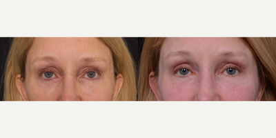 Woman treated with Eyelid Surgery - Woman treated with Eyelid Surgery (upper eyelids)