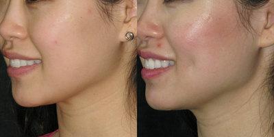 25-34 year old woman treated with Dimple Surgery - Some patients prefer to have a dimple only on one side.