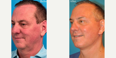 Man treated with Chemical Peel - Man treated with Facelift as well as Neck Lift, Eyelid Surgery, Laser Resurfacing, and Chemical Peel. Patient exhibited the hallmarks of aging face: hooded eyelids, sagging midface, turkey neck and jowls, as well as rough and sun-damaged skin.