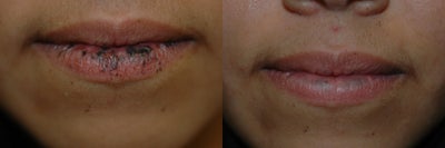 Lip Rejuvenation - 
	Lip spots from Peutz-Jeghers Syndrome before and after q-switched laser treatment with the Palomar Q Yag V.

