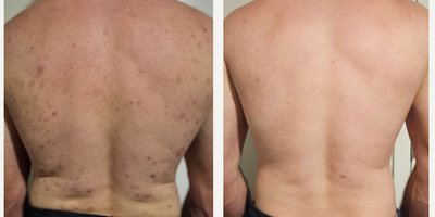 35-44 year old man treated with AviClear - This patient dealt with cystic acne from his adolescents. After a life time of fighting it with diet, skincare products, and harsh perscription medications nothing proved sucessful before he had a series of Aviclear treatments with us at Cedar Grove Aesthetics. Aviclear is the only laser treatment specifically designed for acne. It combines two technologies to target acne-causing bacteria and reduce inflammation all without the use of topical gels or creams. Unlike other laser treatments, Aviclear isnt a temporary solution. It targets acne at its source to treat acne once and for all. This is just one of our very happy patients!