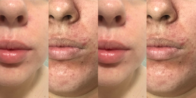 25-34 year old woman treated with Vivace - 2 vivace treatments for acne scar removal