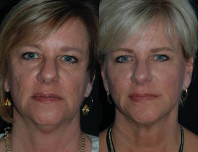 PrecisionTx - Laser Lift and microfat grafting too orbital rims, perioral, and midface.